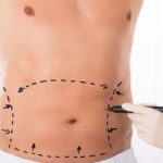 Several benefits of tummy tuck surgery