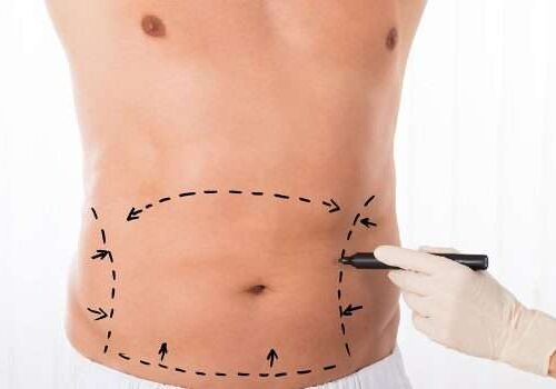 Several benefits of tummy tuck surgery